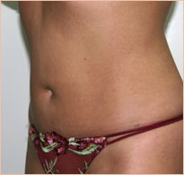 Фото после миниабдоминопластики