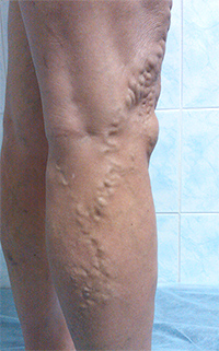 Фото до лечения вен