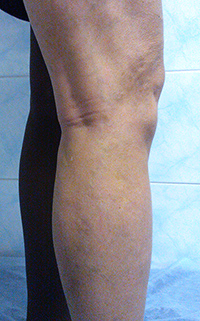 Фото после лечения вен