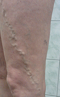 Фото до лечения вен