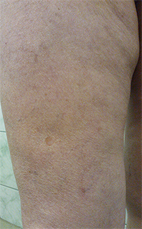 Фото после лечения вен