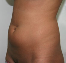 Фото до липосакции