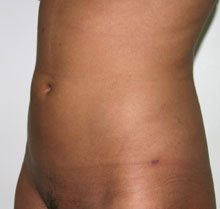 Фото после липосакции