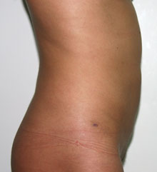 Фото после липосакции