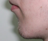 Фото после коррекции формы подбородка