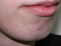 Фото до коррекции формы подбородка