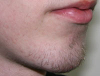 Фото после коррекции формы подбородка