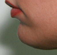 Фото после коррекции формы подбородка