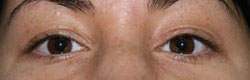 Фото после коррекции птоза (опущения) верхнего века