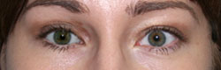 Фото после коррекции птоза (опущения) верхнего века
