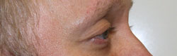 Фото после коррекции птоза (опущения) верхнего века