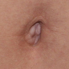 Фото до устранения пупочной грыжи