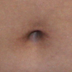 Фото после устранения пупочной грыжи