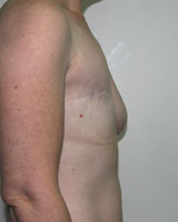 Фото до реконструкции груди