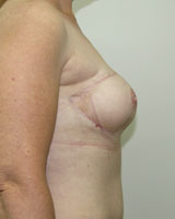 Фото после реконструкции груди