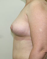 Фото после реконструкции груди