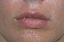 Фото после удаления геля