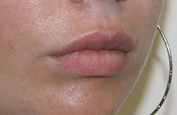 Фото после удаления геля