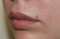 Фото до удаления геля