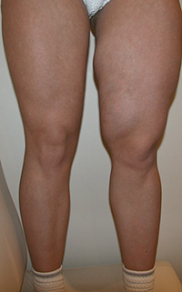 Фото до удаления геля