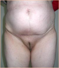 Фото после устранения послеоперационной грыжи