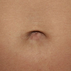 Фото после устранения пупочной грыжи