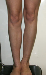 Фото после коррекции асимметрии голеней