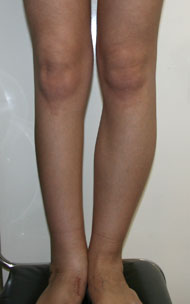 Фото до коррекции асимметрии голеней