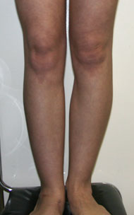 Фото после коррекции асимметрии голеней