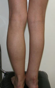 Фото до коррекции асимметрии голеней