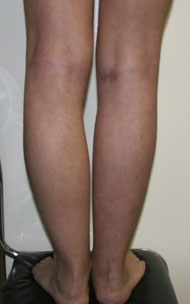 Фото после коррекции асимметрии голеней