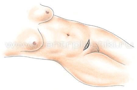 Эндоскопическая абдоминопластика