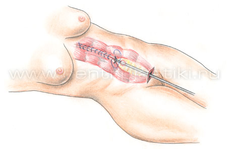 Эндоскопическая абдоминопластика