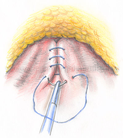 Эндоскопическая абдоминопластика