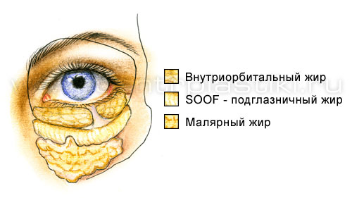 Блефаропластика
