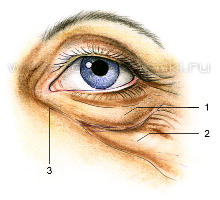 Блефаропластика