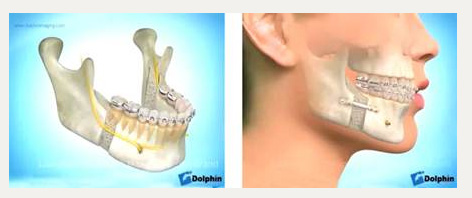 Остеотомия нижней челюсти