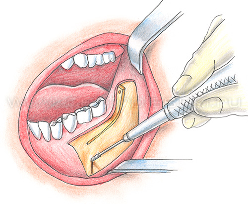 Остеотомия нижней челюсти