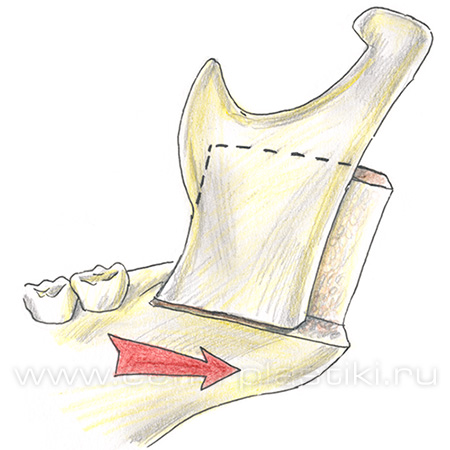 Остеотомия нижней челюсти