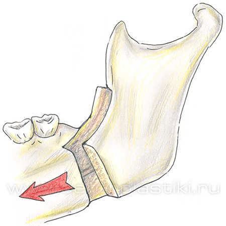 Остеотомия нижней челюсти