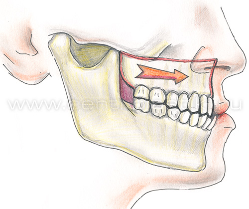 Остеотомия верхней челюсти