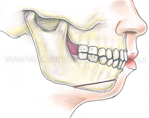 Гениопластика