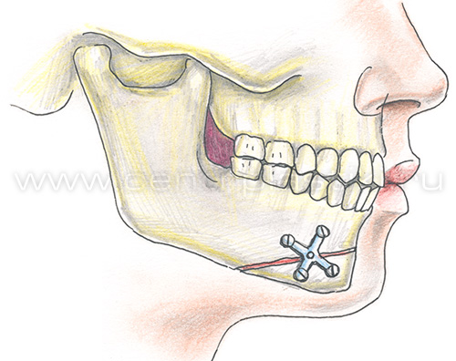 Гениопластика
