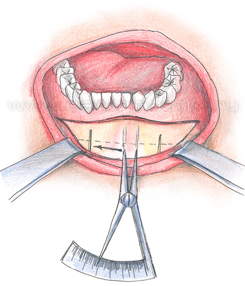 Гениопластика