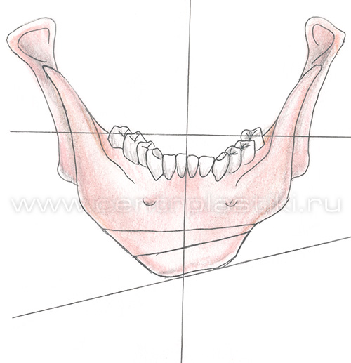 Гениопластика