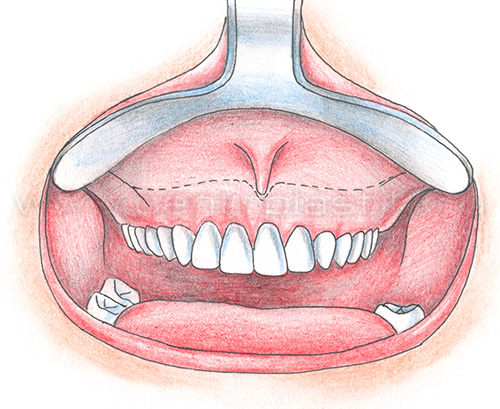 Секторальная остеотомия фронтального отдела верхней челюсти