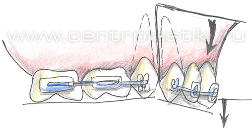 Секторальная остеотомия фронтального отдела верхней челюсти