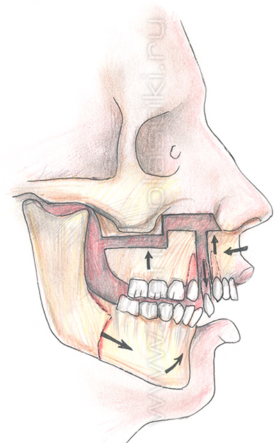 Секторальная остеотомия фронтального отдела верхней челюсти
