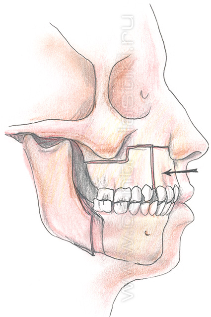 Секторальная остеотомия фронтального отдела верхней челюсти