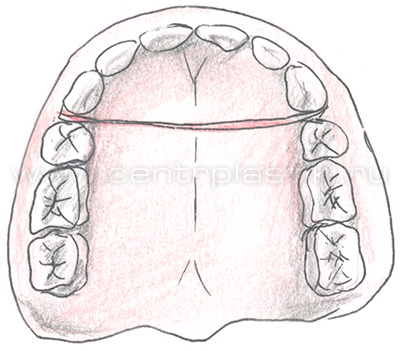 Секторальная остеотомия фронтального отдела верхней челюсти